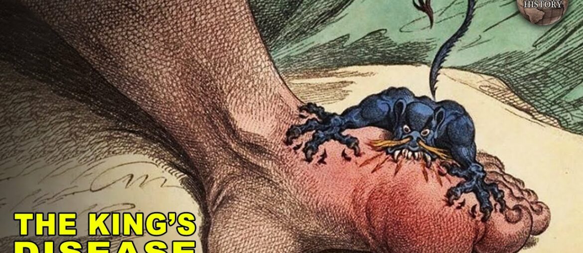 The History of Gout | The Disease of Kings The History of Gout | The Disease of Kings