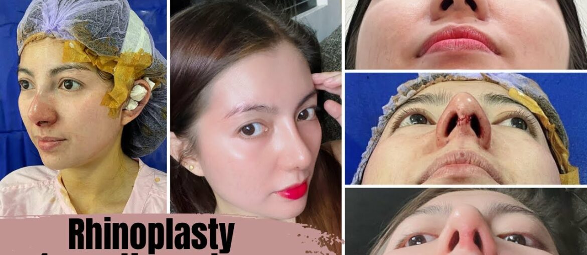 Goretex Rhinoplasty Journey - 1 Month Post Operation (Alar Lift + Tip Plasty)