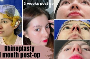 Goretex Rhinoplasty Journey - 1 Month Post Operation (Alar Lift + Tip Plasty)