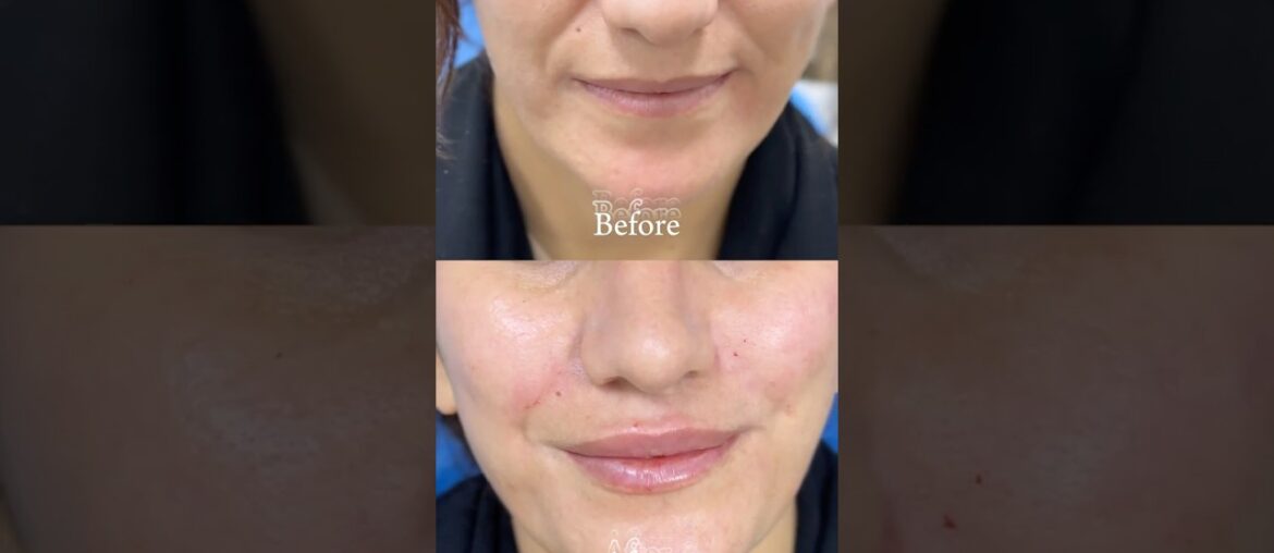 Lip & smile line French Filler injection in Iraq, Duhok