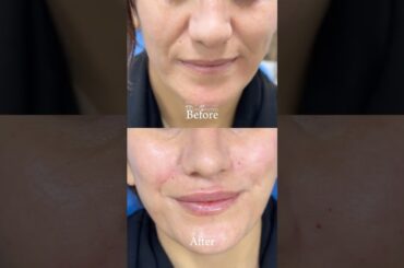 Lip & smile line French Filler injection in Iraq, Duhok
